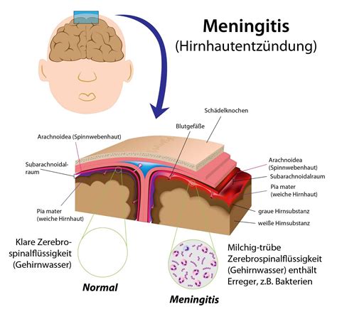 meningitis amboss deutsch